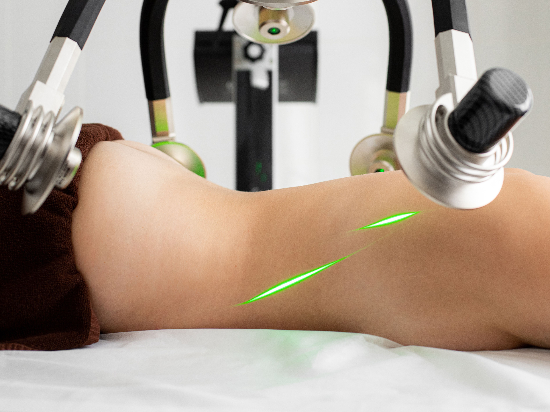 CO2 Laser Resurfacing
